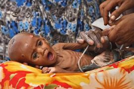 An internally displaced malnourished child receives treatment inside a paediatric ward at the Banadir hospital in Somalia's capital Mogadishu, August 25, 2011. The African Union will hold a much delayed summit on Thursday to raise money to ease the Horn of Africa's famine after mounting criticism over the continent's weak response to the disaster, which has already killed tens of thousands of people. REUTERS/Feisal Omar (SOMALIA - Tags: SOCIETY ENVIRONMENT DISASTER)